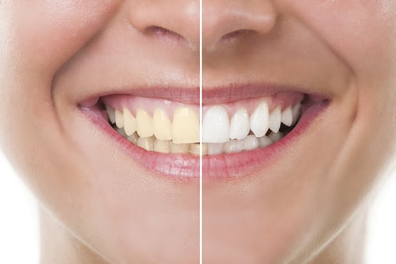 dental patient with before and after teeth whitening procedure